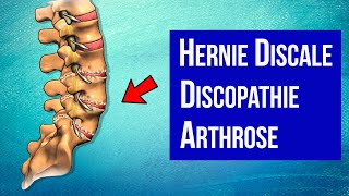 Hernie discale Discopathie Arthrose  Mieux comprendre son mal de DOS [upl. by Eittah]