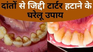 Teeth Tartar Removal Home Remedies दांतों से जिद्दी प्लाक टार्टर दूर करने के घरेलू उपाय Jeevan Kosh [upl. by Esaertal869]