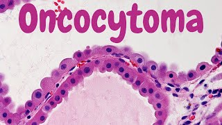 Renal Oncocytoma  Pathology mini tutorial [upl. by Anekam884]