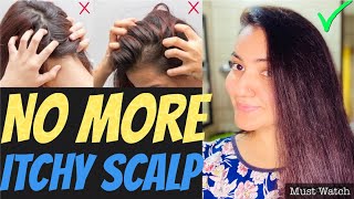 DIY  Extreme DRY amp ITCHY SCALP Treatment at Home  Magical Remedy For LICE SCALP ACNE amp DANDRUFF [upl. by Ilrebmyk307]