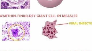 Warthin Finkeldey Giant Cells  Definition Diseases we find them in and Characteristics [upl. by Cristoforo]