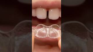 Spacing in between teeth  Teeth Gap Treatment shorts dental viral braces invisalign veneers [upl. by Linad]