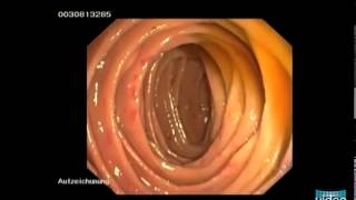 Hereditary Hemorrhagic Telangiectasia OslerWeberRendu Disease [upl. by Nereus]