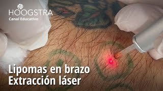 Lipomas en brazo  Extracción láser  24121 [upl. by Ahsin]