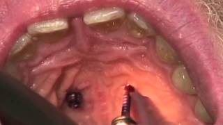 OrthoEasy  Removal of pin palatinal in maxilla [upl. by Sweatt869]