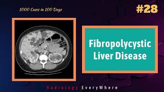 Fibrocystic liver diseases Radiology  1000 cases in 100 days  video 28  Radiology Everywhere [upl. by Groveman78]