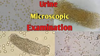 Urine Microscopic Examination  Differenc Between pus cell amp RBCs  UTI [upl. by Nna]