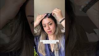 Derma Roller hair growth results are amazing Hair regrowth journey with derma roller 05 haircare [upl. by Rachael]