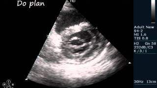 MSMR RHD ECHOCARDIOGRAPHY SERIES BY DRANKURKCHAUDHARI [upl. by Remot]