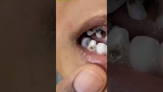 Teeth Whitening Treatment At Home shorts ytshorts shortviral [upl. by Ihteerp]