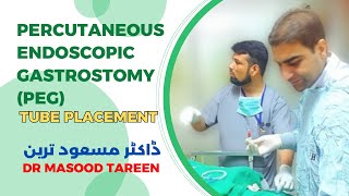 Percutaneous endoscopic gastrostomy PEG tube placement  Dr Masood Tareen [upl. by Aneelahs806]