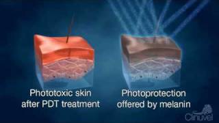 Clinuvel improving quality of life  Photodynamic Therapy PDT [upl. by Ebby33]