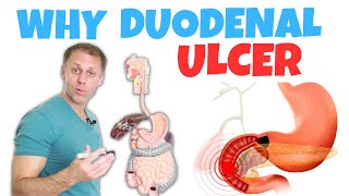 Understanding a Duodenal Ulcer [upl. by Secnirp]