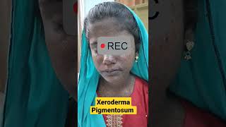 Xeroderma Pigmentosum  DermaCase  Basal cell amp Squamous cell Carcinoma  Sun induced Pigmentation [upl. by Ahsykal]