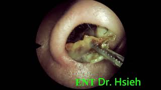 ENT local treatment after RT 3 weeks 010 鼻中膈鼻道成形手術術後三週耳鼻喉局部治療 [upl. by Nrublim]