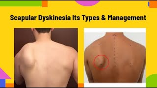 Scapular DyskinesiaWining of Scapula Its types amp Management  PhysiotherapyKnowledge [upl. by Amhsirak]