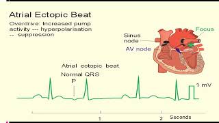 EKG itu Gampang Sesi 3Aritmia Dasar [upl. by Clerissa728]