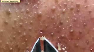 This is a simple video of removing blackheads from the nose using tweezers  3 hours シンプル角栓除去長時間動画 [upl. by Anjanette]