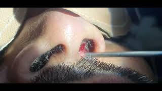 Nose abscess  Nose furuncle  Incision and drainage  Dr Hitesh Patel [upl. by Clarise]