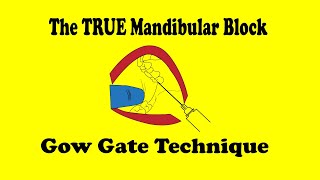 Gow Gate mandibular block [upl. by Niryt]