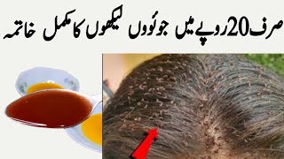 Lice killer home remedies  lice removal  head lice removal  how to get rid of lice  lice [upl. by Keemahs]