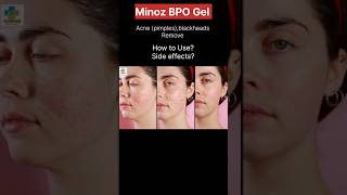 Minoz BPO Gel  Acne treatment [upl. by Clava]