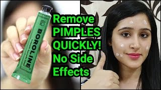 Remove PIMPLES amp ACNE IN 3 DAYS  NATURAL amp EASY METHOD [upl. by Acirahs]