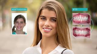 Carriere patients Video showing before and after braces [upl. by Yevre]