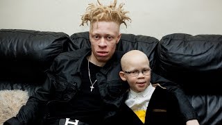 Model With Albinism Inspires Kids With Condition  BORN DIFFERENT [upl. by Ttevy]