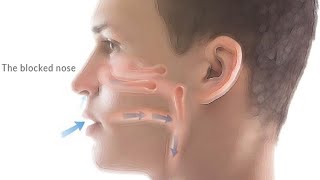 ACUPUNCTURE TREATMENT FOR BLOCKED NOSE NASAL CONGESTIONCHRONIC SINUSITIS [upl. by Ahcsat]