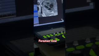 Tabique interventricular y foramen oval [upl. by Mercer]