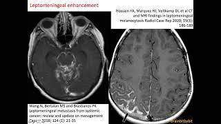 30 Meningeal enhancement pachymeninges leptomeninges subarachnoid lymphatic like membrane SLYM [upl. by Marguerie373]