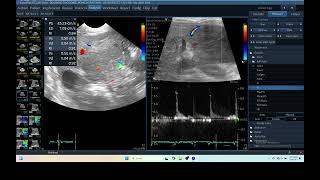 IQ 279 LIVER ULTRASOUND HEPATOMA ECHOPAC ANALYSIS ECHOCARDIOGRAPHY CFM PW MODE 2 [upl. by Elletsirk]