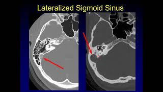 CT of the Temporal Bone Prior to Cochlear Implantation [upl. by Ikairik]