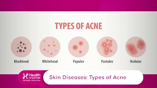 Types of Acne [upl. by Reinert]