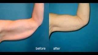 Exercises For Flabby Arms شد ترهل الذراعين [upl. by Alanna]