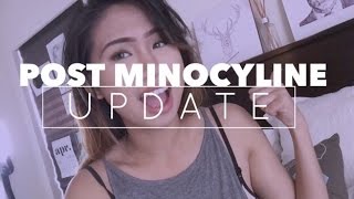 Post Minocycline Acne  Skin Update  nicolevlogs [upl. by Tomchay]