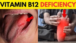 Vitamin B12 Deficiency Symptoms  B12 Deficiency  Vitamin B12  All You Need to Know [upl. by Lady]