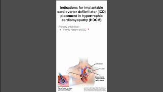 Indications for implantable cardioverterdefibrillator placement in hypertrophic cardiomyopathy [upl. by Aiyekal183]