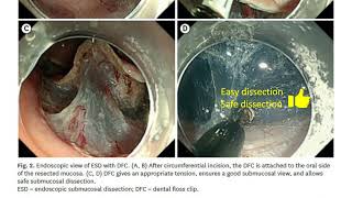 DFC indications for Gastric ESD [upl. by Jezabel]