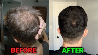 I Took Minoxidil For 1 Year Heres What Happened [upl. by Noivart906]