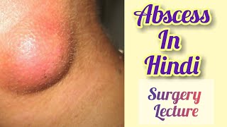 Abscess in hindi  PYOGENIC ABCESS  SURGERY lecture by Tarangini goswami  BHMS surgery [upl. by Hbaruas]