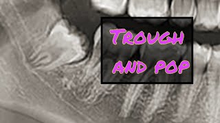 Buccal Trough and Quick Elevation of this Wisdom Tooth [upl. by Enirual]