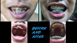 Braces transformation time lapse  Everyday Photo  2 Months [upl. by Benedikt]