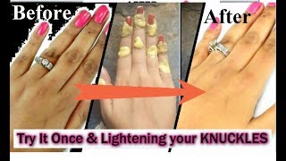 उंगलियों के जोड़ों की काली त्वचा से छूटकारा पाए  Lightening your KNUCKLES  Finger Joints [upl. by Gehman]