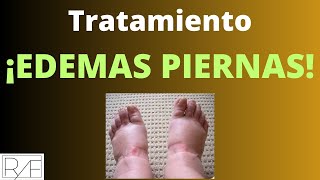 Tratamiento de Piernas Hinchadas con quotAcupunturaquot [upl. by Annalla]