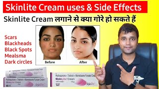 Honest Review of skinlite cream in Hindi  गोरेपन की क्रीम  uses and side effects of skinlite cream [upl. by Einahpts]