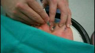 Retrobulbar injection for cataract surgery anesthesia [upl. by Arakaj]