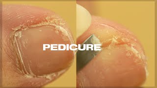 Satisfying PEDICURE TRANSFORMATION at home  Cuticle amp Callus Removal [upl. by Eciralc]