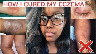 HOW I CURED MY ECZEMA FOREVER [upl. by Eldwin596]